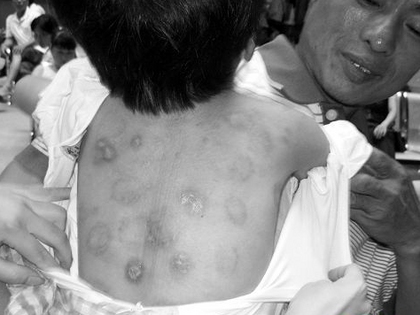 最近脸上会有一块一块红的印迹、脱皮、会痒、