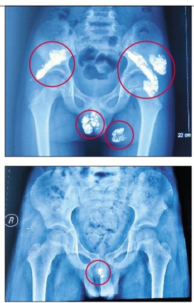 奇奇入院时（上图）及手术后的X光片（下图），圈中为汞显影。