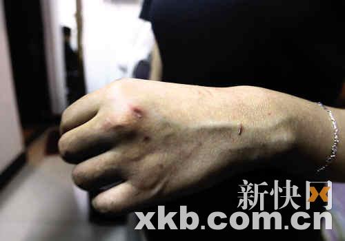 女事主的手被歹徒抓伤.新快报见习记者毕志毅/摄
