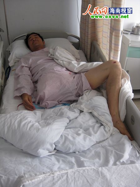 三亚一男子与城管争执时意外被撞致右腿截肢