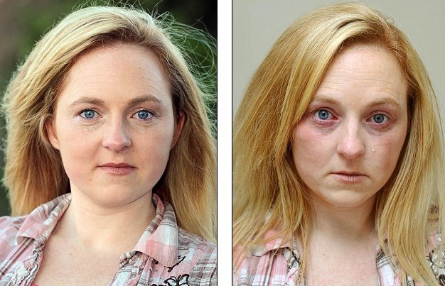 英国女子皮肤对水严重过敏