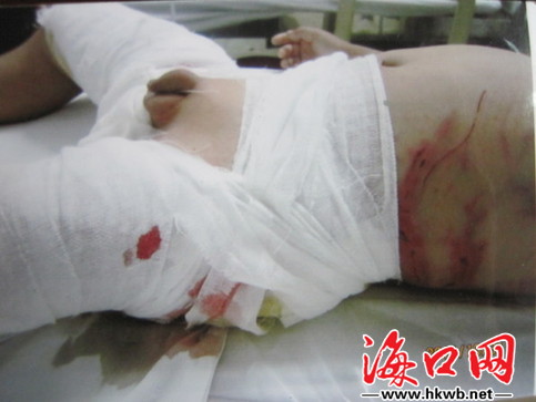 但却因为<em>肛门</em>处的括约肌伤势严重