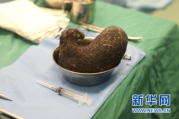 花季女孩胃中竟然塞满了头发